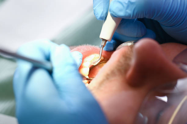 Best Emergency Root Canal Treatment in Long Beach, CA